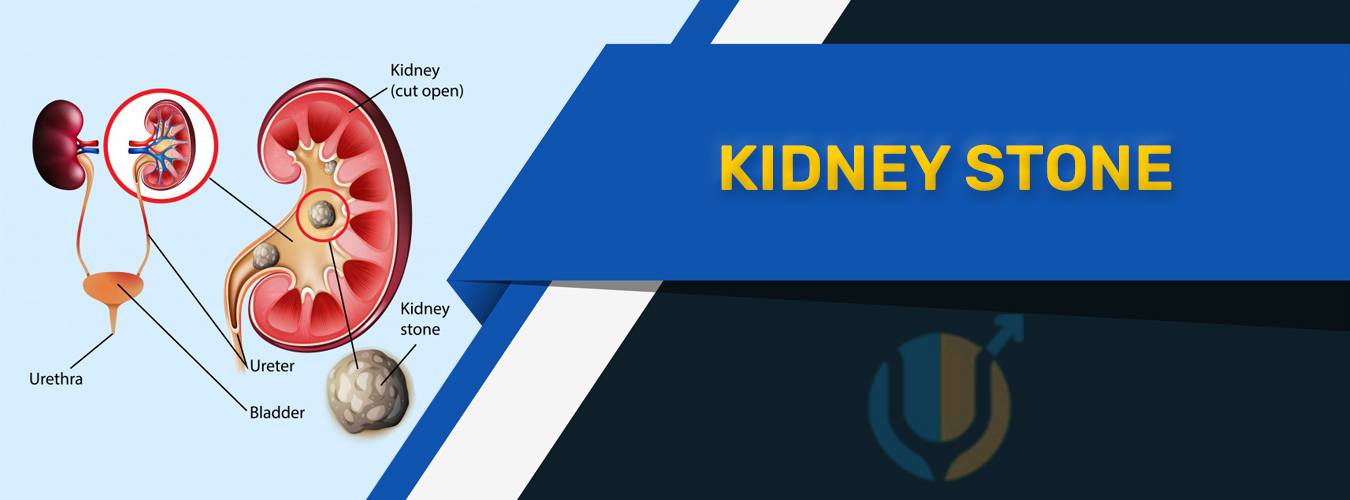 Kidney Stone Treatment in Pune