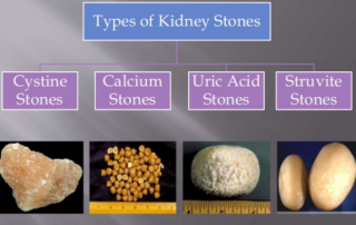 Type of Kidney Stone