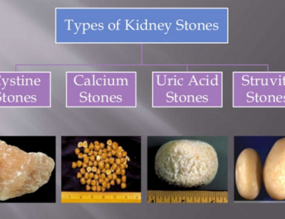 Stages of Kidney Cancer Treatment - Dr. Irfan Shaikh | Urolife Clinic, Pune