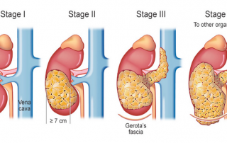 Stages of Kidney Cancer
