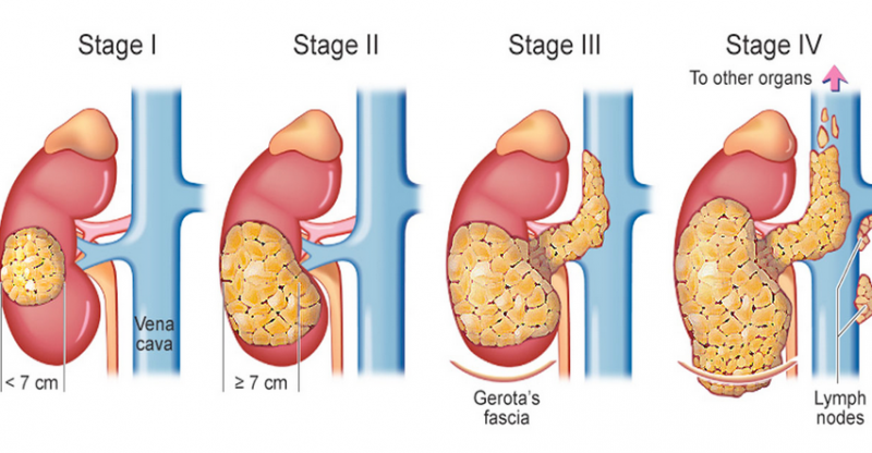 stages-of-kidney-cancer-treatment-dr-irfan-shaikh-urolife-clinic-pune