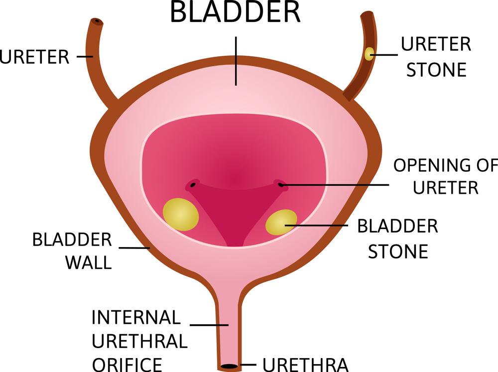 Urinary Bladder Stone Treatment In Pune Dr Irfan Shaikh