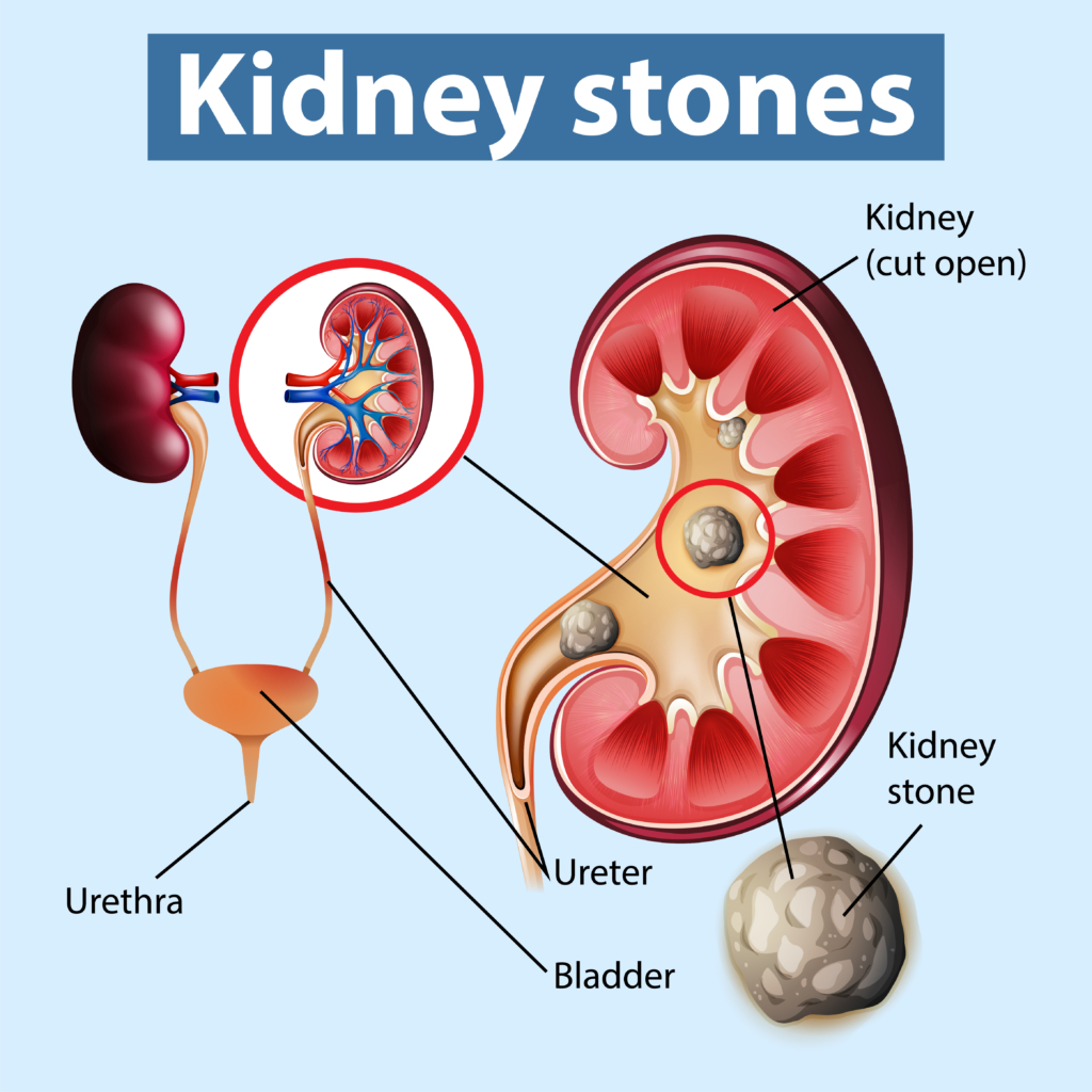 PCNL Surgery For Kidney Stone Removal Urolife Clinic Pune