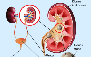 Kidney Stone Treatment in Pune