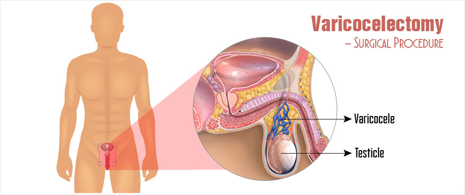 What is the recommended treatment for varicocele to assist with