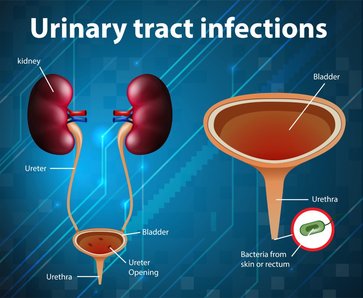 Urinary Tract Infection Archives Urolife