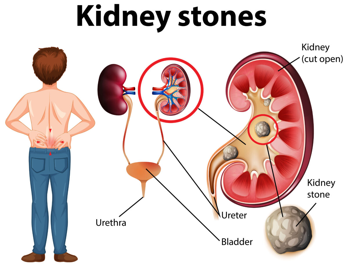 kidney-stone-urolife