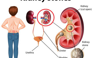 किडनी स्टोन (Kidney Stone)