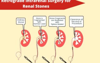 Retrograde Intrarenal Surgery( RIRS) Surgery in PUNE
