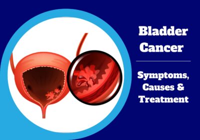 Bladder Cancer : Symptoms, Causes & Treatment | UroLife Clinic