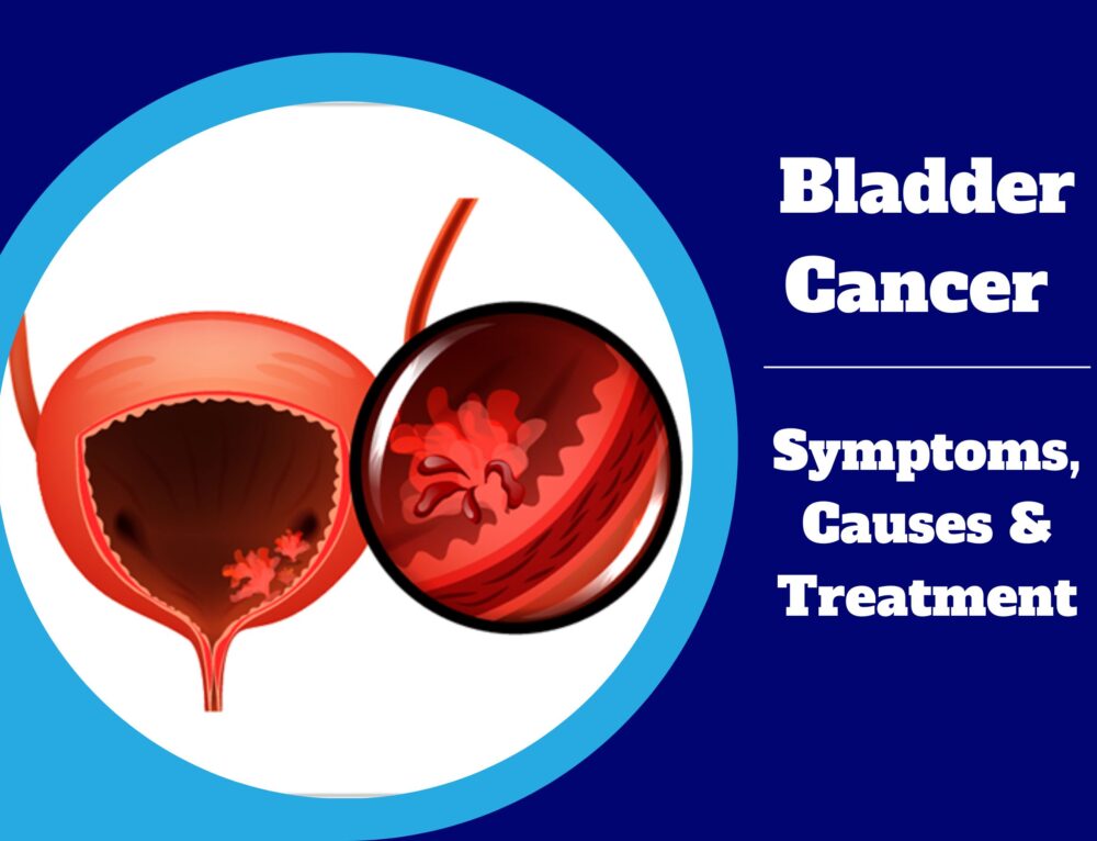 Stages of Kidney Cancer Treatment - Dr. Irfan Shaikh | Urolife Clinic, Pune