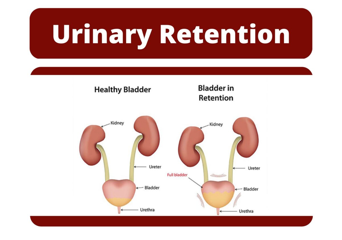 Urinary Retention Urolife Clinic