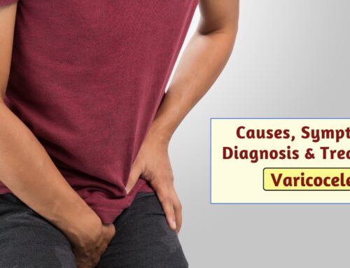 Varicocele – Causes, Symptoms, Diagnosis & Treatment